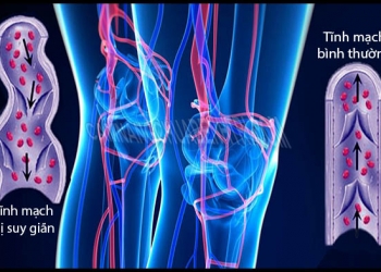 Siêu âm màu Doppler 4D chẩn đoán suy van tĩnh mạch chi dưới