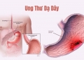Tầm soát Ung thư Hệ Tiêu hóa