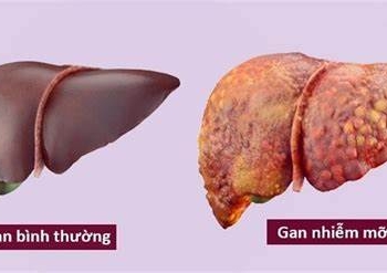 ‘SÁT THỦ ÂM THẦM’ GAN NHIỄM MỠ.