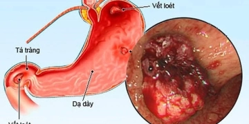 Viêm loét dạ dày tá tràng: Căn bệnh phổ biến hiện nay.
