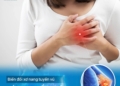 Xơ nang tuyến vú – Biến đổi xơ nang tuyến vú và cách phòng ngừa