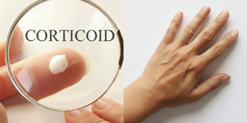 🧴 Vì sao bôi thuốc corticoid khiến da mỏng và sạm hơn?