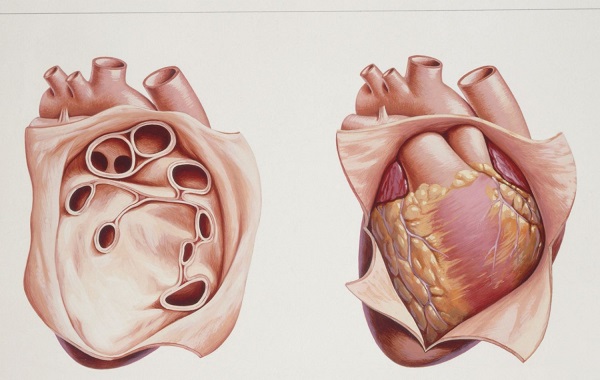 benh tim mach o tre-viem mang ngoai tim