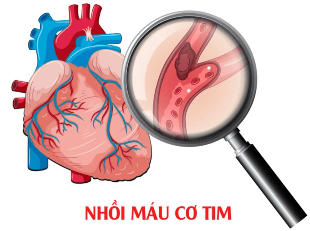 nhồi máu cơ tim là gì
