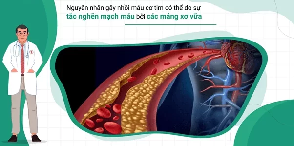 Nguyên nhân nhồi máu cơ timm