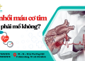 Bị nhồi máu cơ tim có phải mổ không?
