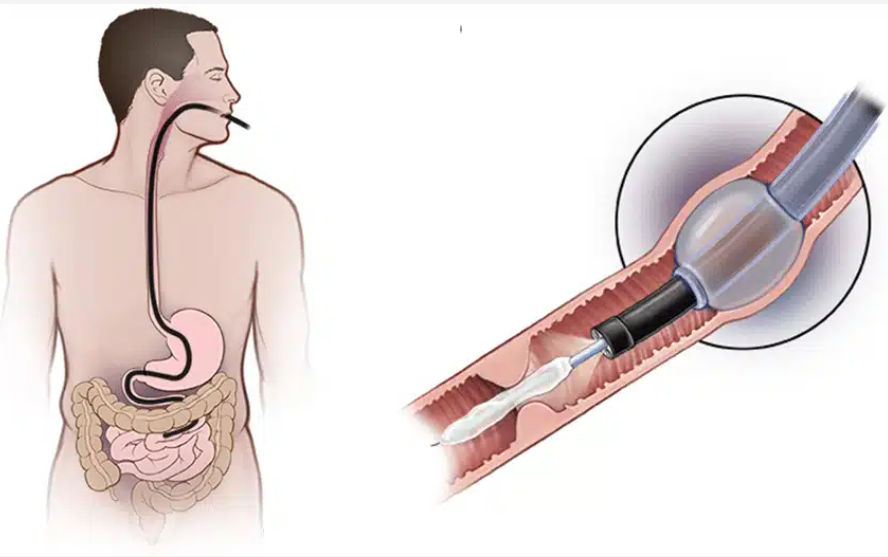 cac phuong phap noi soi ruot non