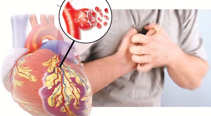 Đột quỵ tim là gì?