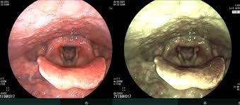 hinh anh cua noi soi tai mui hong