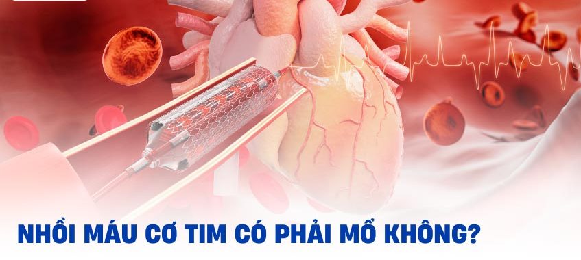 Bị nhồi máu cơ tim có phải mổ không ?