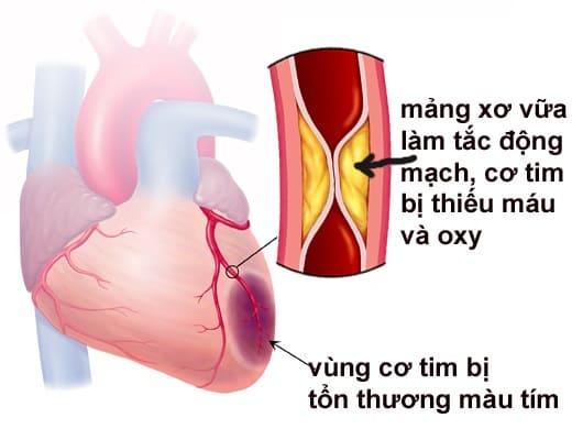 Nhồi máu cơ tim là gì