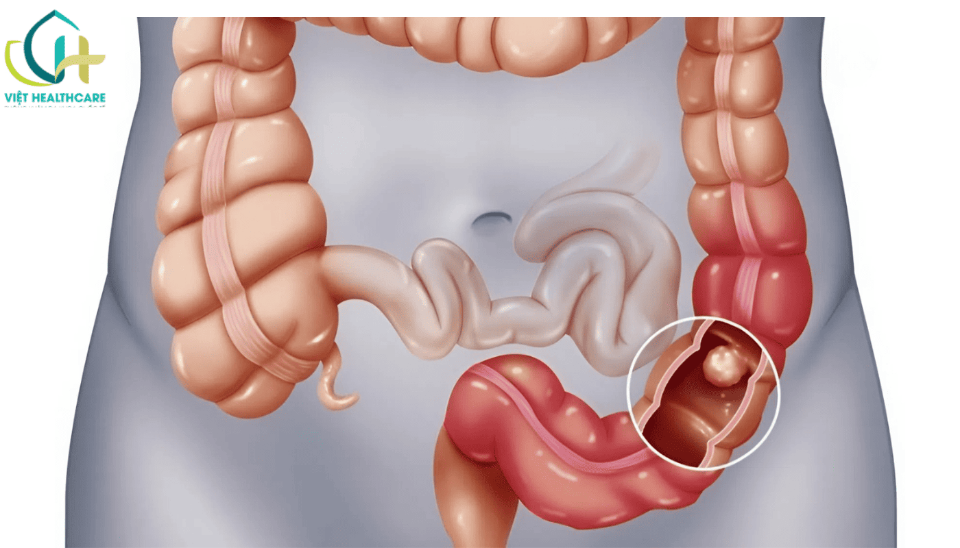 noi soi trực tràng