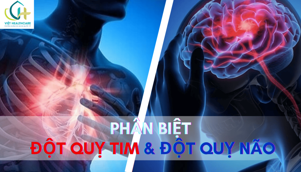 Phân biệt đột quỵ tim và đột quỵ não