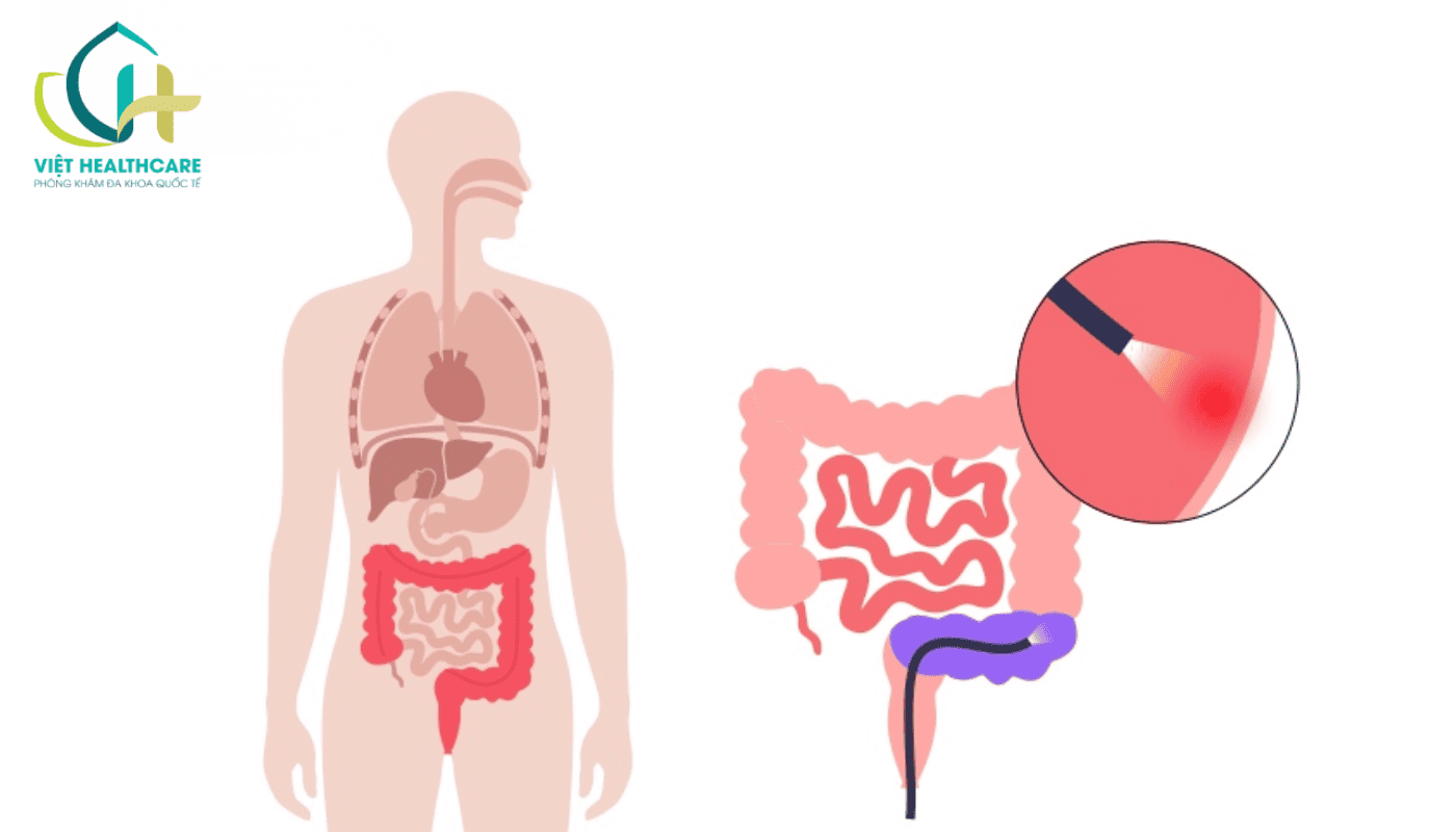 tai sao can noi soi duong ruot