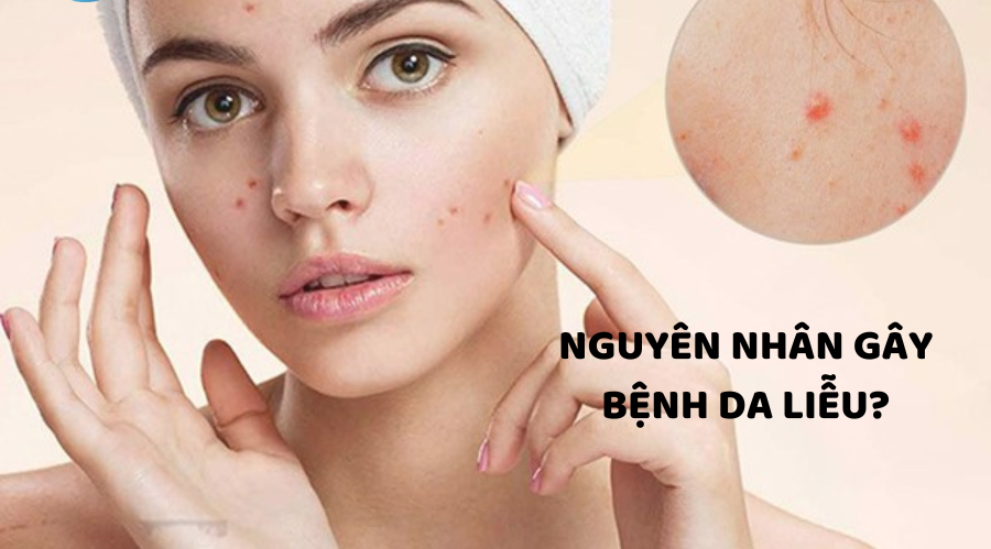 Nguyên nhân gây bệnh da liễu