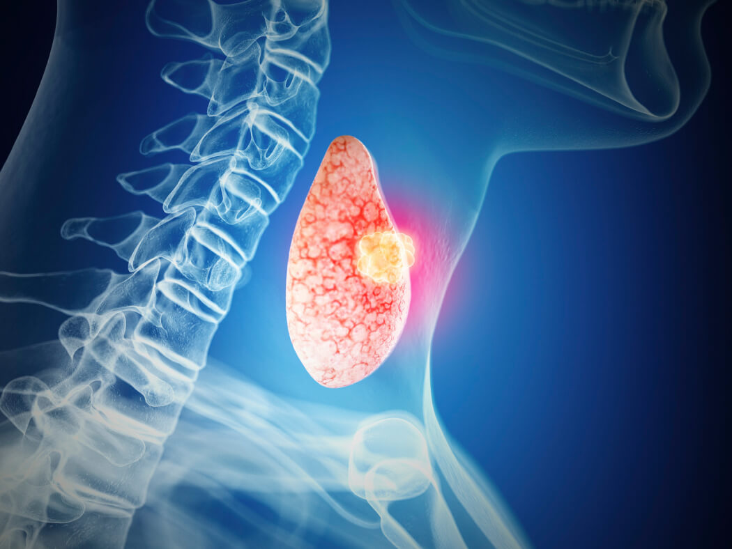 ung-thu-tuyen-giap-2